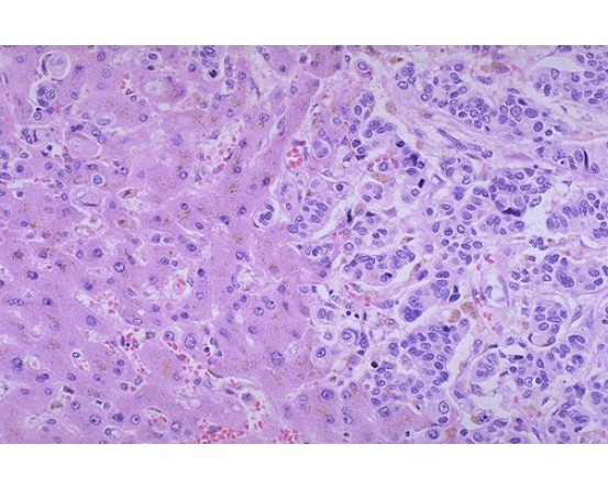 MASTER DIAGNOSTICA Hepatocarcinoma Panel in India