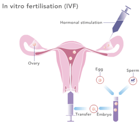 In Vitro Fertilization