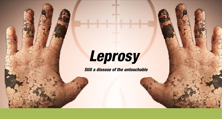 Leprosy – still a disease of the untouchable