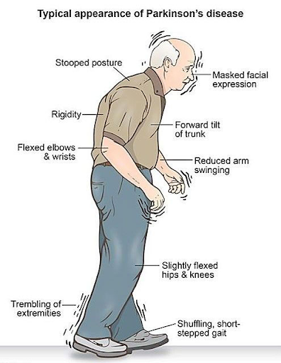 Parkinson’s Disease