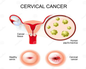 Cervical Cancer