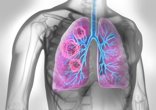 Lung-cancer-Symptoms