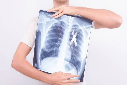 Lung-cancer